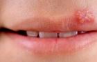 How to treat herpes on the lips in children