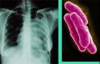 How to treat pulmonary tuberculosis at home: tips