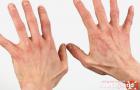 Cum să vindeci eczemele mâinilor acasă