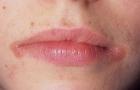 Vad orsakar klibbiga fläckar i läpparnas hörn och hur man behandlar dem hemma