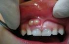 How to cure gum gum gums at home?
