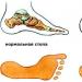 How to quickly and effectively get rid of dry calluses on your feet at home