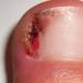 How to treat an ingrown toenail at home