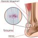 Tendinit - beskrivning, orsaker, diagnos, behandling Tendinit på foten enligt ICD