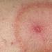 Tick-borne borreliosis (Lyme disease) - symptoms, treatment and consequences of borreliosis