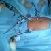 All about epidural anesthesia during childbirth How epidural anesthesia affects the heart