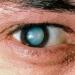 Causes of eye cataracts Methods of restoring vision after surgery