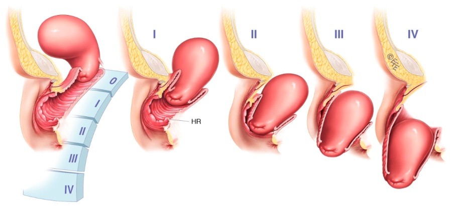 Este posibil să rămâneți gravidă cu prolaps uterin: caracteristici și pericole ale afecțiunii